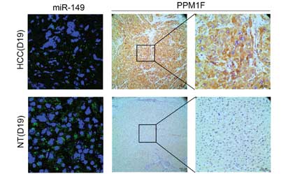 miR-149 represses metastasis of hepatocellular carcinoma by targeting actin-regulatory proteins PPM1F