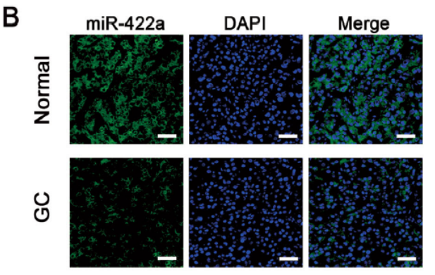 MiR-422a regulates cellular metabolism and malignancy by targeting pyruvate dehydrogenase kinase 2 in gastric cancer