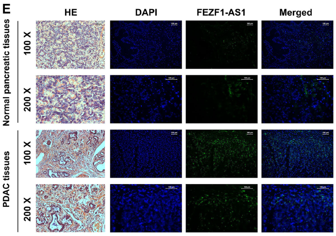 FEZF1-AS1/miR-107/ZNF312B axis facilitates progression and Warburg effect in pancreatic ductal adenocarcinoma