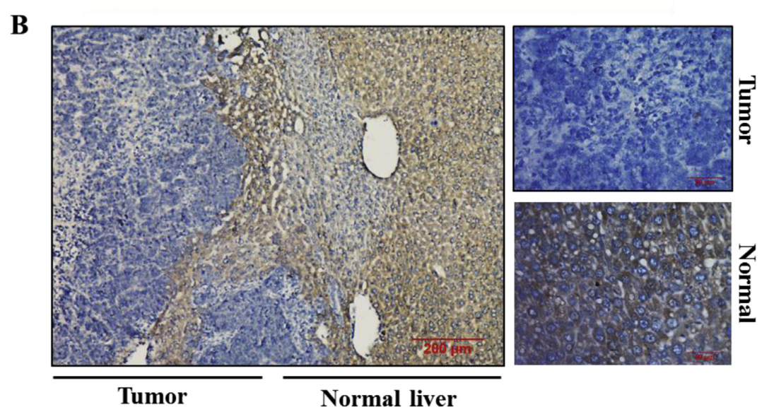 Inhibition of microRNA-16 facilitates the paclitaxel resistance by targeting IKBKB via NF-kB signaling pathway in hepatocellular carcinoma