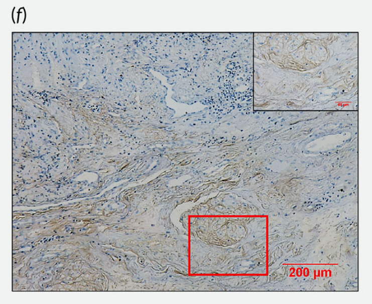 Cancer-associated fibroblasts promote PD-L1 expression in mice cancer cells via secreting CXCL5