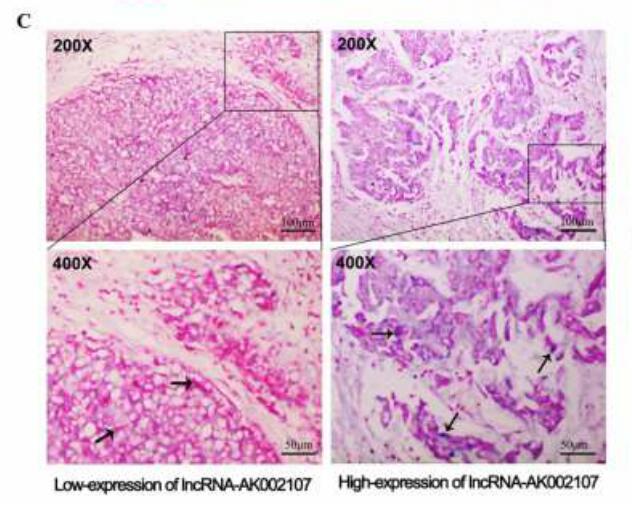   The long noncoding RNA AK002107 negatively modulates miR-140-5p and targets TGFBR1 to  induce epithelial-mesenchymal transition in hepatocellular carcinoma