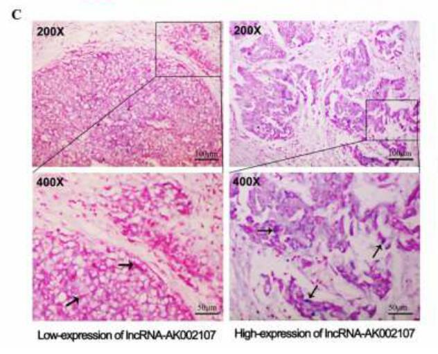   The long noncoding RNA AK002107 negatively modulates miR-140-5p and targets TGFBR1 to  induce epithelial-mesenchymal transition in hepatocellular carcinoma