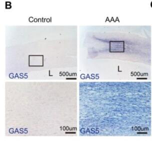 Long noncoding RNA GAS5 induces abdominal aortic  aneurysm formation by promoting smooth muscle  apoptosis 