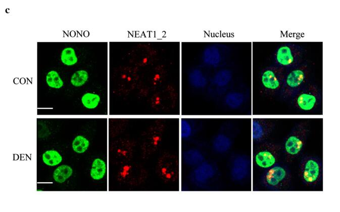 NONO promotes hepatocellular carcinoma progression by enhancing fatty acids biosynthesis through interacting with ACLY mRNA