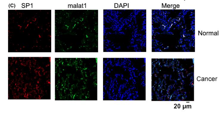 Long non-coding RNA metastasis-associated lung adenocarcinoma transcript 1 promotes lung adenocarcinoma by directly interacting with specificity protein 1