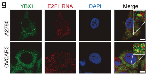 RNA m5C modification upregulates E2F1 expression in a manner dependent on YBX1 phase separation and promotes tumor progression in ovarian cancer